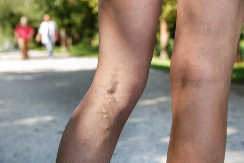 Natuurlijke middelen tegen spataderen en teleangiëctasieën zoals toverhazelaar