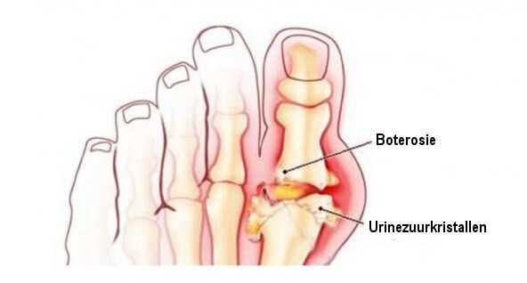 Wat kun je tegen urinezuur doen om het te verminderen