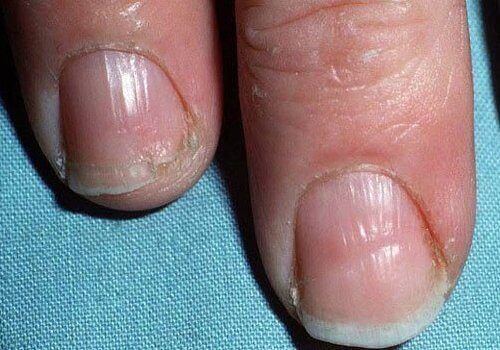Broze nagels