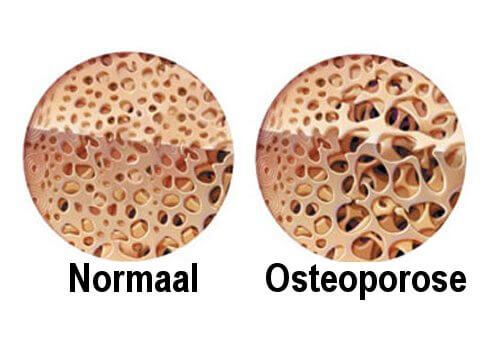Osteoporose
