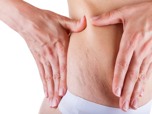 Striae