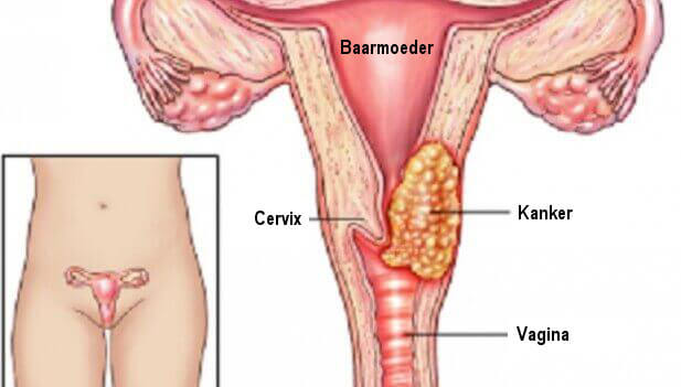 Deze 7 factoren kunnen leiden tot baarmoederhalskanker