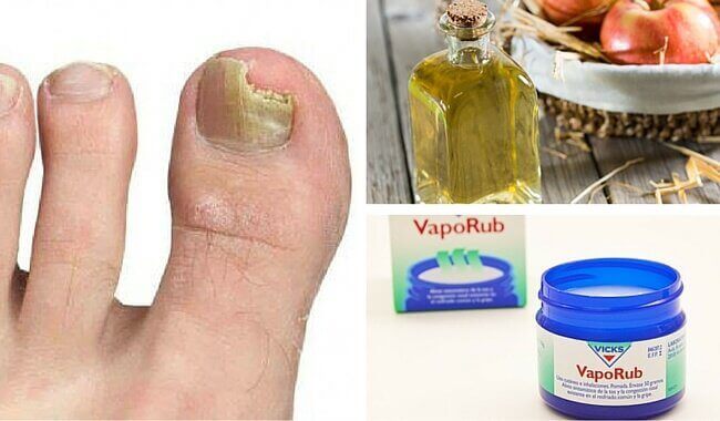 6 natuurlijke middelen tegen nagelschimmel