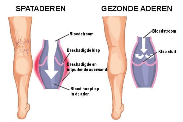 Ongezonde Aderen