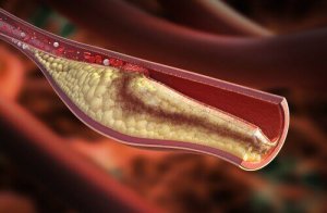Symptomen van een hoog cholesterolgehalte