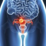endometriose Endometriose