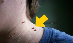 Zes natuurlijke manieren om skin tags te verwijderen