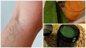 Grootmoeders' middel tegen spataderen