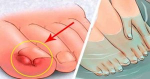6 huismiddelen tegen ingegroeide teennagels