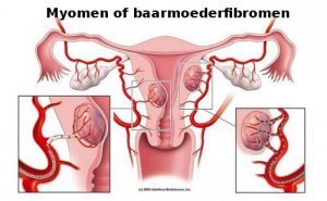 Een vleesboom of myoom: 5 dingen die je moet weten