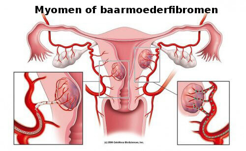 Een vleesboom of myoom: 5 dingen die je moet weten