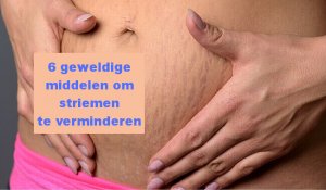 Zes geweldige middelen om striemen te verminderen