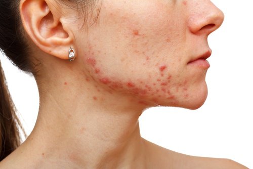 Een alternatieve manier om uien te gebruiken is tegen acne