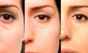 Hoe kom ik van die wallen onder mijn ogen af?