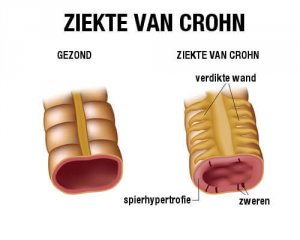 De ziekte van Crohn behandelen met het juiste dieet