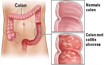 Colitis