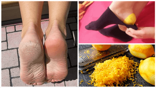 Gebruik citroenschil voor gezonde voeten