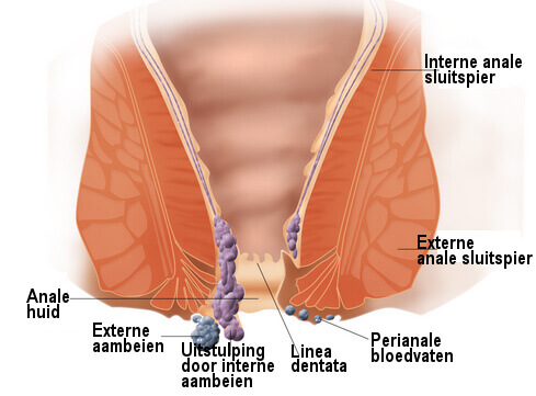 Aambeien