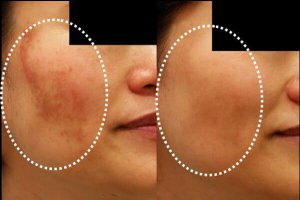 Natuurlijke behandelingen voor melasma