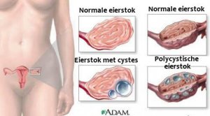 Wat elke vrouw moet weten over ovariumcysten