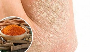 Zeven natuurlijke manieren om psoriasis tegen te gaan