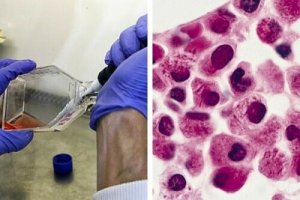 Wetenschappers ontdekken therapie waardoor leukemiecellen zichzelf aanvallen