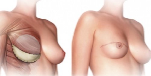 Wat zou je voorafgaand aan een mastectomie moeten weten?