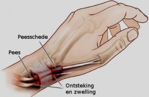 Peesschedeontsteking in de handen en voeten