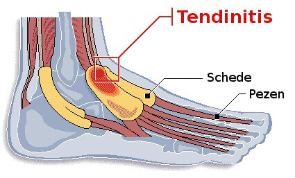 Tendinitis in de voet