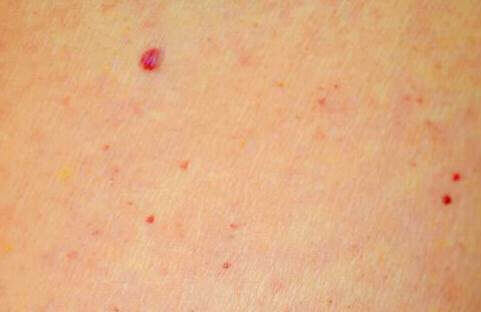 Moet ik me zorgen maken over rode vlekjes op de huid