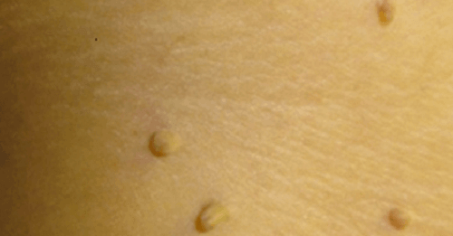 Vicks VapoRub bij wratten