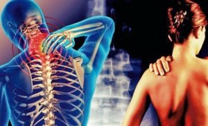 Cervicobrachiaal syndroom: pijn die vanuit de nek naar de armen uitstraalt