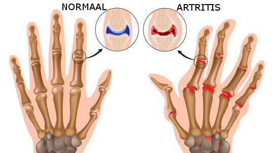 Artritis in de Hand