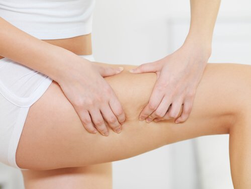 Cellulite op het Bovenbeen