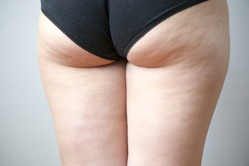 Afbeeldingsresultaat voor cellulite