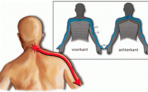 Wat veroorzaakt het cervicobrachiaal syndroom