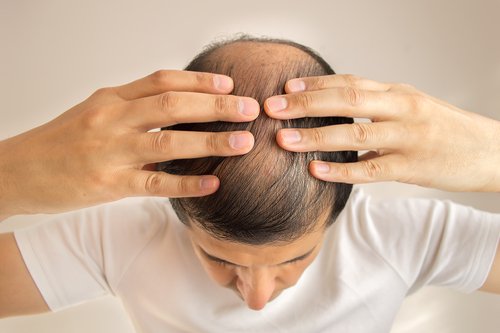 Gelokaliseerde alopecia en grijze haren kunnen een teken van een overwerkte lever zijn