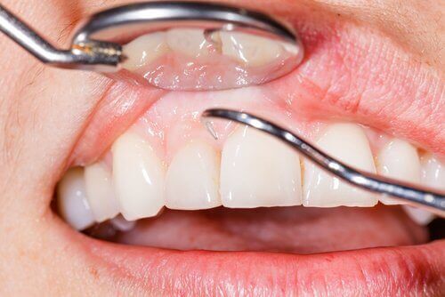 Ontsteking van het tandvlees en de keel kan een teken zijn van een overwerkte lever