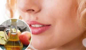 Moedervlekken verwijderen op een natuurlijke manier