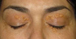 Xanthelasma: een wit vlekje rondom de ogen