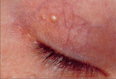Xanthelasma