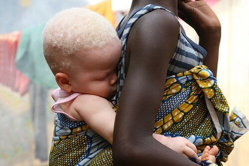 Het albinisme in Afrika