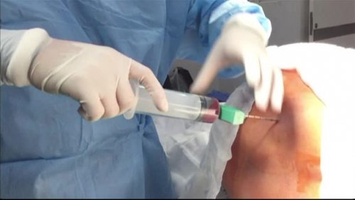 Persoon ondergaat een beenmergtransplantatie