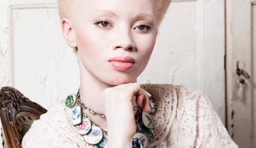 Albinisme: het verhaal van model Thando Hopa