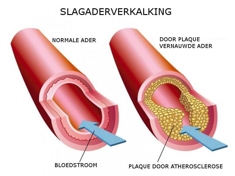 Atherosclerose