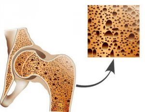 Osteoporose bestrijden met natuurlijke behandelingen