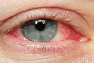 Natuurlijke middelen tegen geïrriteerde ogen