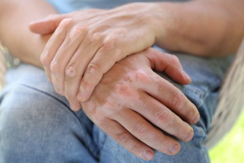 Huismiddeltjes om vitiligo te behandelen