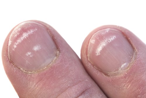 Witte vlekjes op je nagels: waarom heb je ze?
