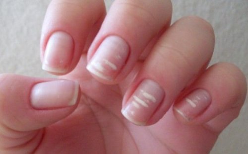 Witte Vlekjes op de Nagels